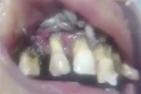 dentist takes    disgusting case   mouth full