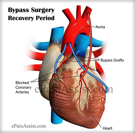 heart bypass surgery civil milk
