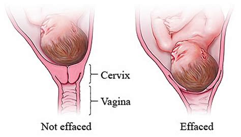 cervical effacement cervix thinning signs  cervix  thinning
