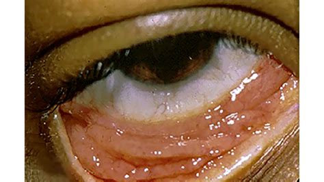 Chlamydia In Eye Pictures Causes Treatment And More