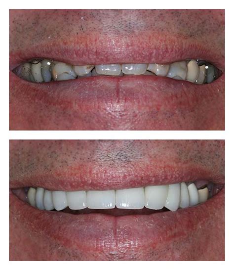 Dental Crowns Before And After Bartholomew Dentist