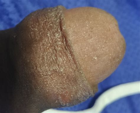 what could this be penis disorders forums patient