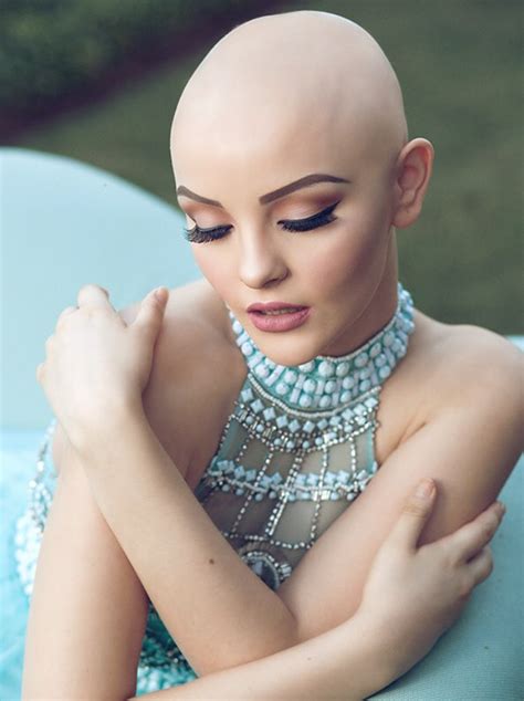 Bald Teen Goes Viral Uses Glamorous Photoshoot To Spread