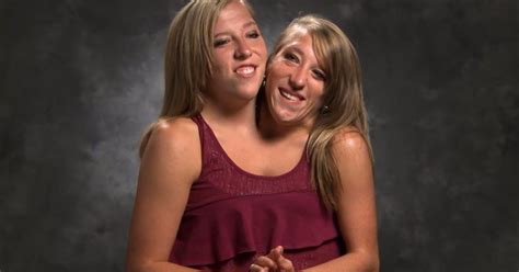 27 Year Old Conjoined Twins Stun Fans With Huge Life