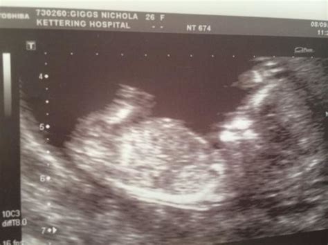 13 weeks scan picture skull theory gender prediction what do you think netmums chat