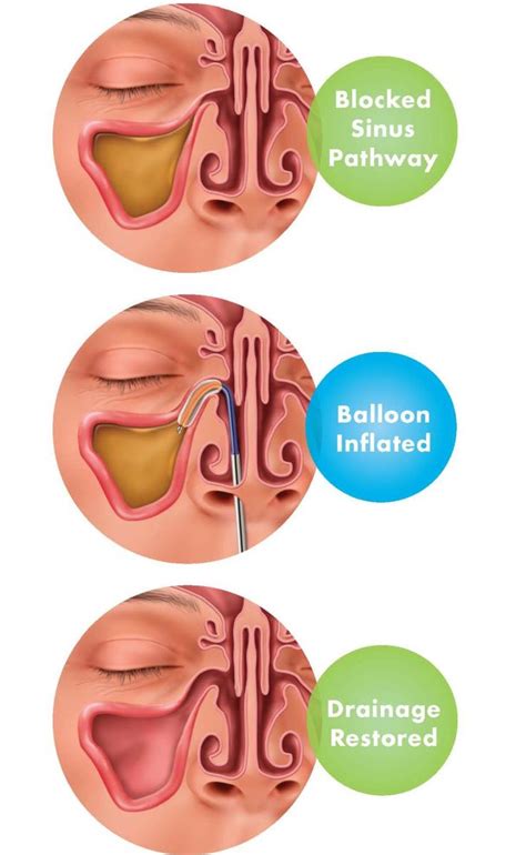 sinus surgery fess drgauri belsare