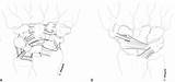 Wrist Instabilities Dorsal Ligaments sketch template
