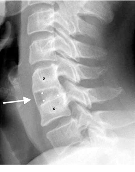 Figure 1 From Anterior Cervical Interbody Fusion With