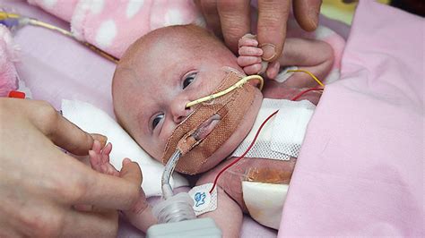 Британские врачи спасли малышку которая родилась с сердцем наружу