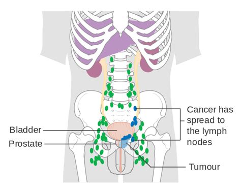 File Diagram Showing Prostate Cancer That Has Spread To The Lymph Nodes