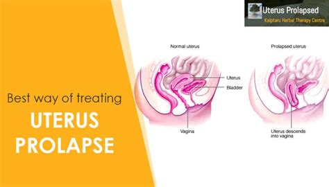 want to treat uterus prolapse quickly read more in 2021 prolapsed