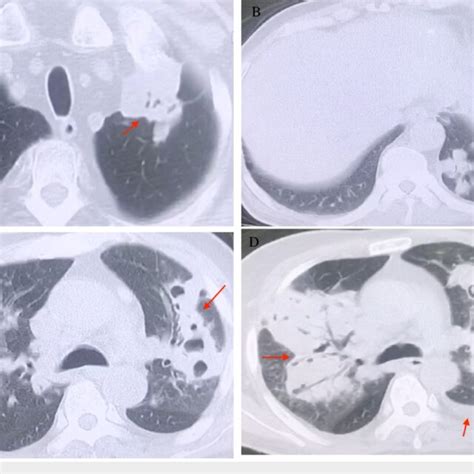 Chest Ct Of The Patients A Mass In The Left Upper Lobe B Multiple