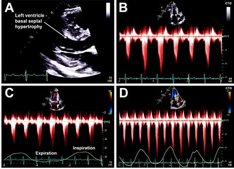 marked respiratory related variation  lvot gradients  hypertrophic cardiomyopathy  obese