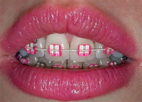 Think Pink I Took The Plunge Metal Mouth Message Board Aparelho