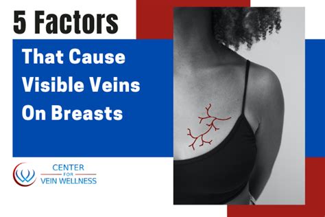 5 Factors That Cause Visible Veins On Breasts
