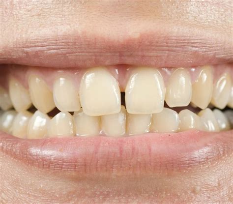 bleach teeth  teeth whitening products