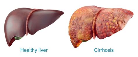 liver disease symptoms perth liver specialists liver surgeons
