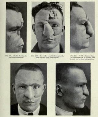 plastische chirurgie werd noodgedwongen populair door de eerste wereldoorlog tonic