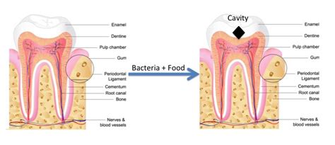 cavities         canyon dental