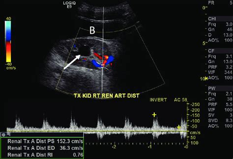 transplant kidney partial torsion transverse ultrasound    scientific diagram