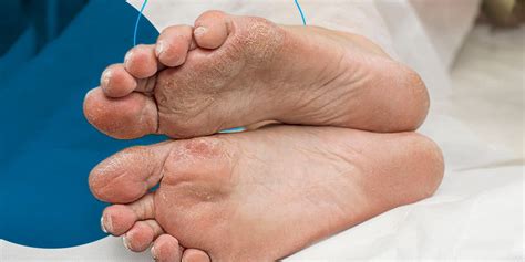 importance  foot care  diabetes foot health fasa
