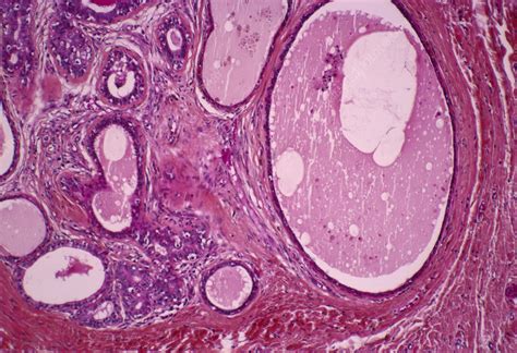 Breast Hypertrophy Light Micrograph Stock Image M122 0342