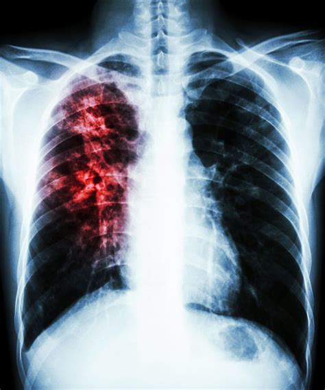 tuberculosis  ray chest xray image pa view show pulmonary