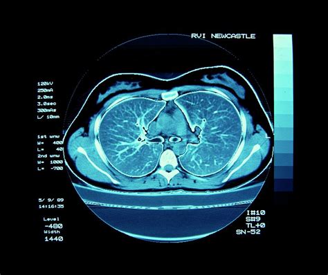 Normal Lung Ct Scan