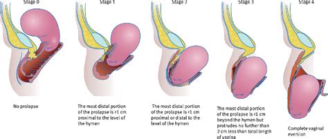 Figure 2 From Pelvic Organ Prolapse Semantic Scholar