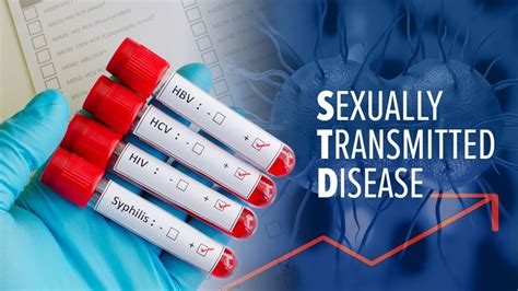 sexually transmitted diseases in san diego county hit 20