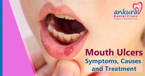 canker sores on lips and tongue
