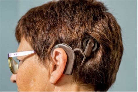Severe Hearing Loss In Adults Finding Out Whether Cochlear Implants Or