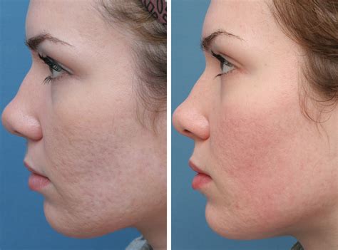 acne scar treatment in indore at shreya s allskin clinic in indore india