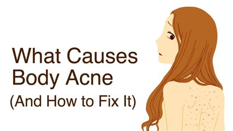 what causes body acne and how to fix it