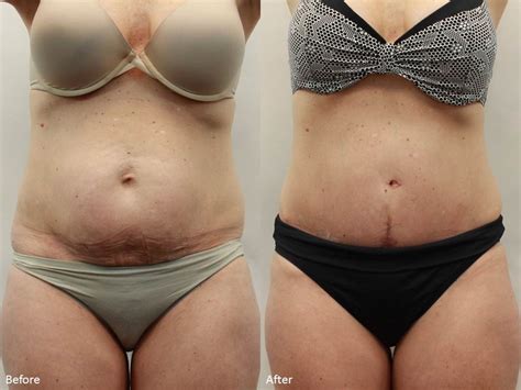 Getting Rid Of Excess Tummy Skin And Fat After Pregnancy