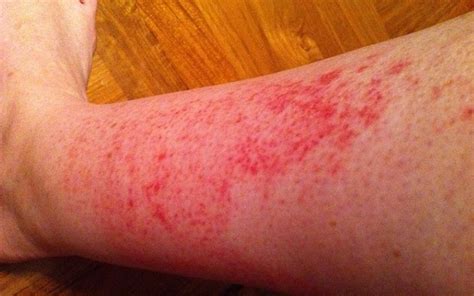 rash  leg  itchy relief treatment remedies skincarederm