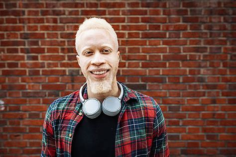 symptoms    achromasia albinism