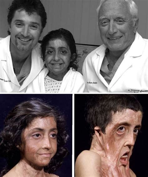 Burn Victim Gets Amazing Facial Reconstruction Medizzy