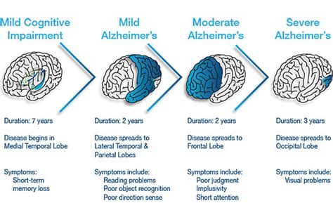 what are the three stages of alzheimer s disease senior directory