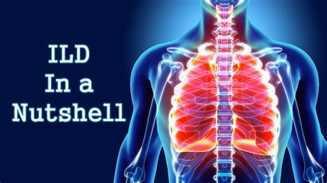 Interstitial Lung Disease Ild In A Nutshell Youtube