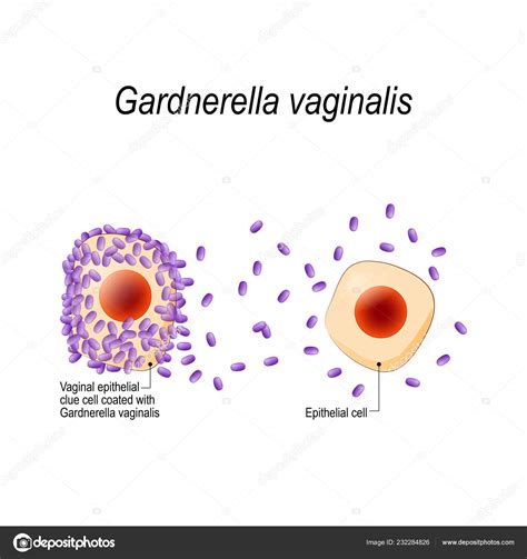 gardnerella vaginal infection xxx photo