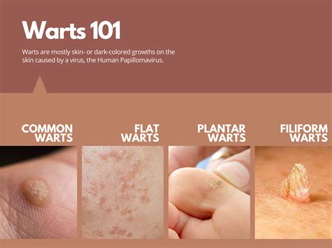 The Derma Corner The 101 On Warts Potential Treatments