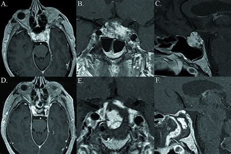 cureus endoscopic endonasal surgery for the resection of a cavernous