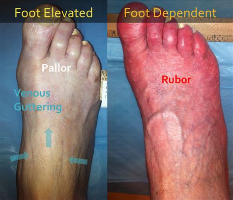 clinical evaluation   foot  peripheral arterial disease