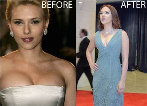 blogging news around world scarlett johansson breast reduction before and after