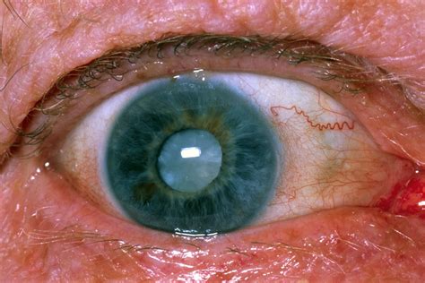 cataracts  signs symptoms surgery recovery complications
