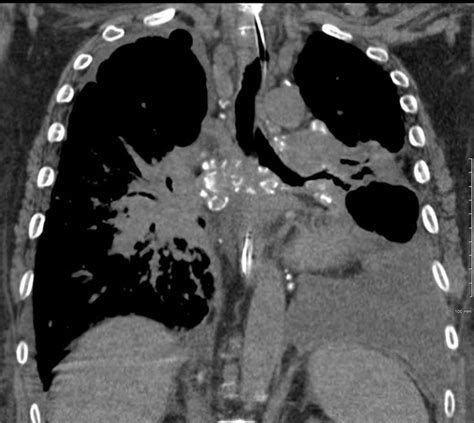 Faces Of Calcified Mediastinal Nodes Lungs