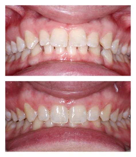 Clear Braces Before And After Bartholomew Dentist