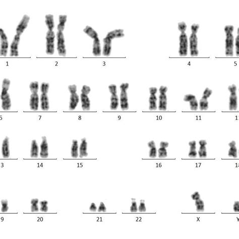 Karyotype 46 Xy 9qh By Gtg Banding Technique Download Scientific