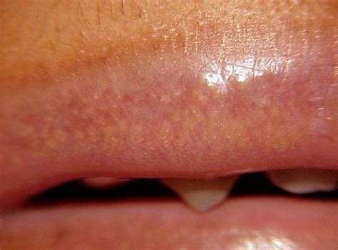 white spots  lips pictures treatment   january
